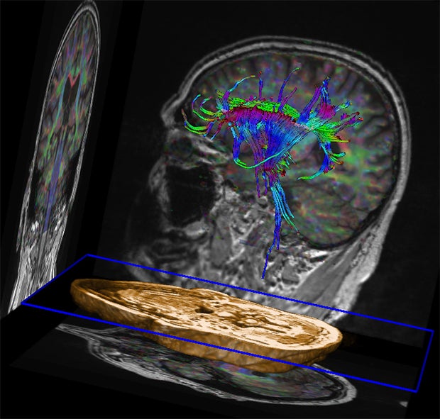 New AI-Powered Tool Automatically Quantifies Brain Volumes Using MR Data