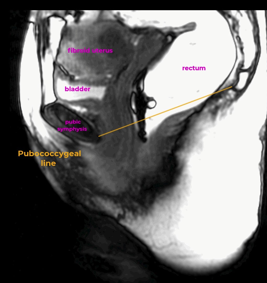 New Recommendations Issued for MR Defecography