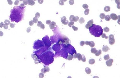 Deep learning may help doctors choose better lung cancer treatments