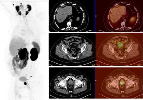 68Ga PSMA PET/CT improves initial staging of high-risk prostate cancer patients