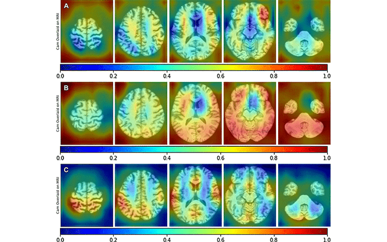 MRI-Based Deep Learning Predicts Biomarkers of Alzheimer Disease