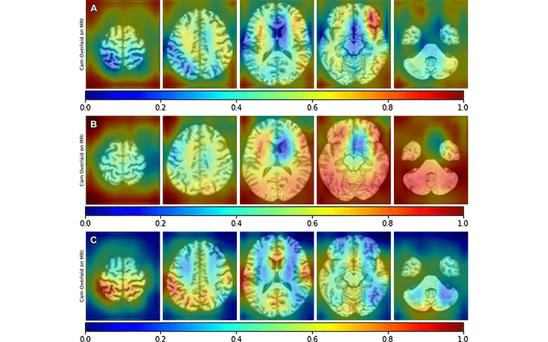 MRI-Based Deep Learning Predicts Biomarkers of Alzheimer Disease