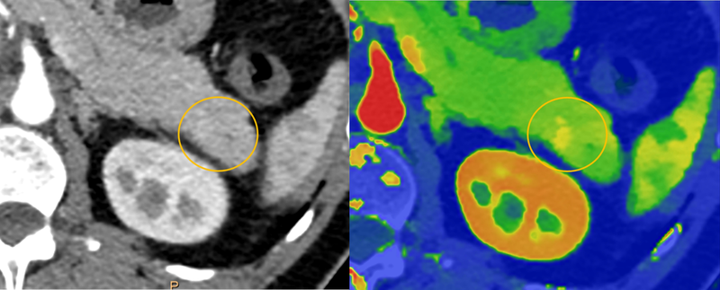 Using AI With Prediagnostic CT May Catch Pancreatic Cancer Earlier