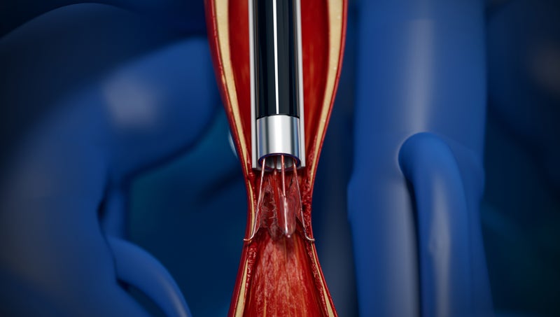 Minimally Invasive IVC Filter Removal Successful in First Patients