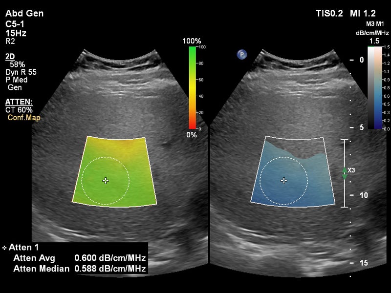 Liver Fat Quantification Tools Released for Philips EPIQ Elite and Affiniti Ultrasound Systems