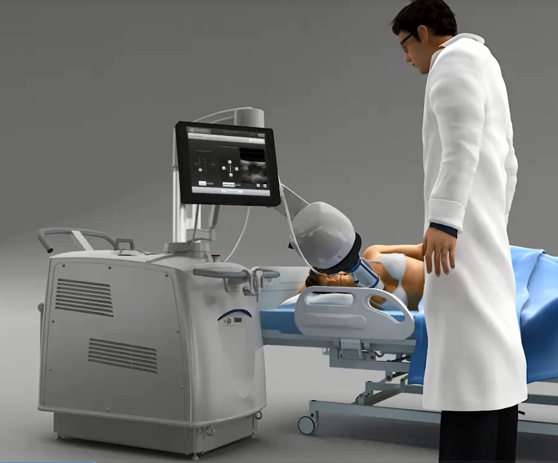 USgHIFU Effective for Breast Fibroadenomas