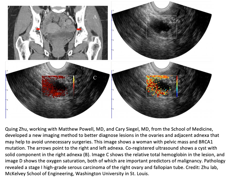 Photoacoustic Imaging Improves Diagnostic Accuracy of Ultrasound in Ovarian Cancer