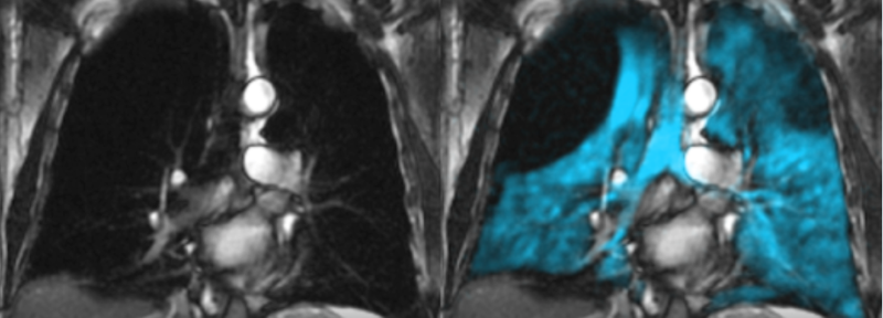 FDA Approves Hyperpolarized Xenon for MRI