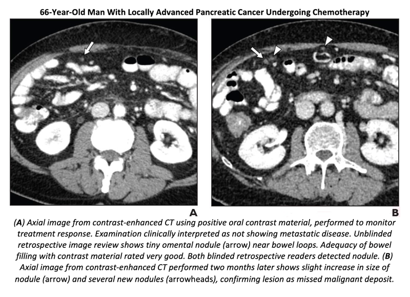 Positive Oral Contrast With Optimized Bowel Prep Improves Detection of Malignancy on CT