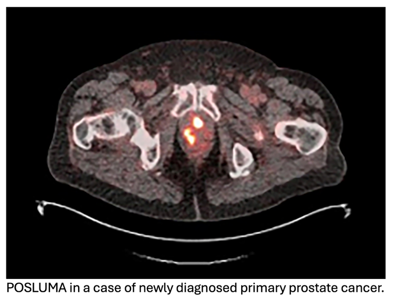 Blue Earth Diagnostics, Siemens Healthineers to Collaborate on AI-Based Tools for Prostate PET Imaging