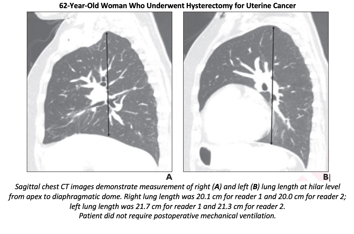 Preoperative Thoracic CT Improves Risk Assessment for Postoperative Mechanical Ventilation