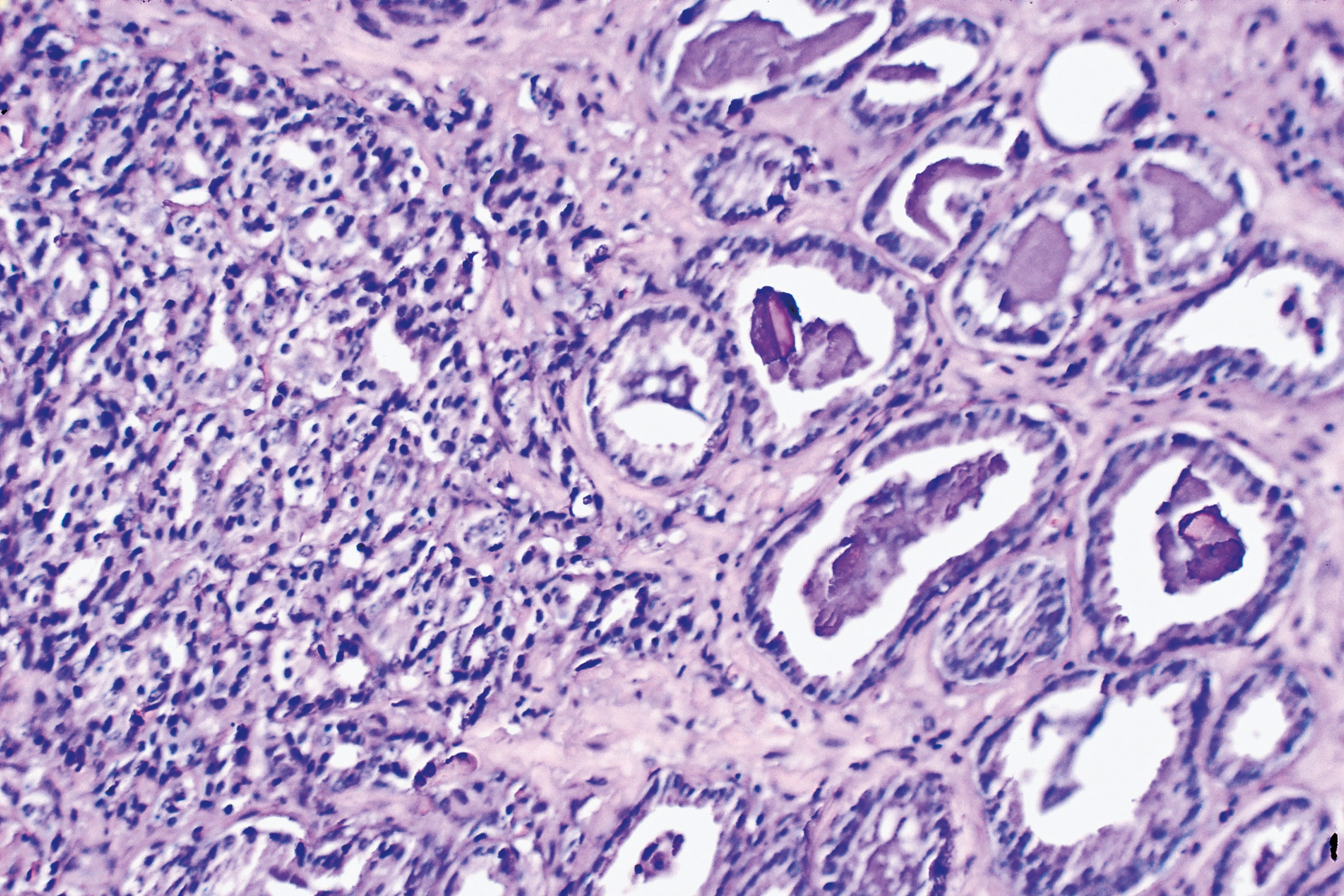 New Collaboration Will Explore Radioguided Surgery for Prostate Cancer