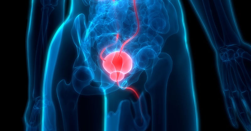 Prostate Artery Embolization Provides Long-Term, Highly Effective Treatment