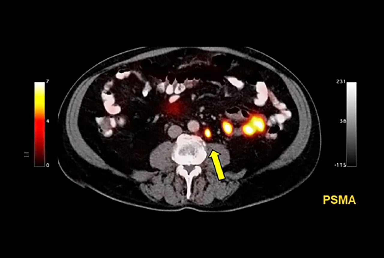 Companies Sign Distribution Agreement for Prostate Cancer Diagnostic