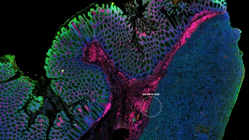 Specific Proteins Linked to Immunotherapy Resistance in Metastatic Colorectal Cancer