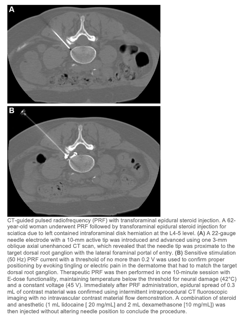 Steroids With Pulsed Radiofrequency Better at Relieving Sciatica Pain