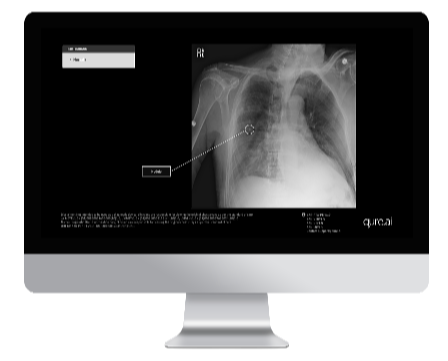 Qure.ai Unveils AI-Powered Lung Cancer Care Continuum at ASCO 2024