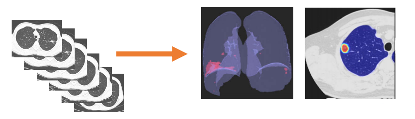 Multi-Center Study Presented at ECR Reports Reduced Report Turn-Around Times for Chest CT using AI