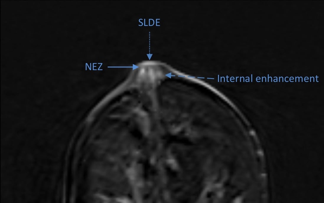 RSNA 2017: Nipple enhancement anatomy on breast MRI