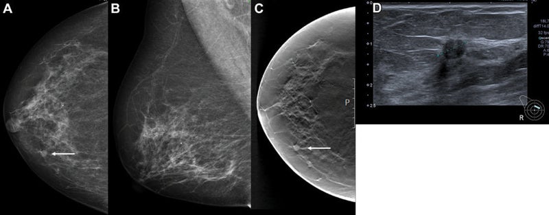AI A Promising Tool for Breast Cancer Detection