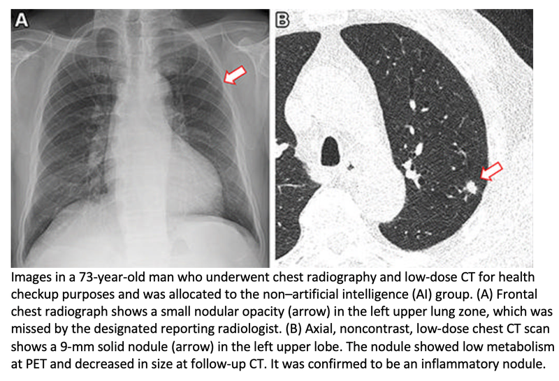 AI Improves Detection of Lung Nodules on Chest X-ray