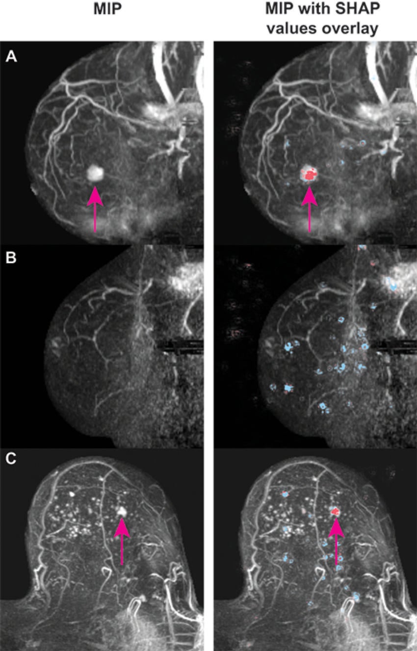 DENSE Trial Indicates AI Helps Rule Out Cancer in Dense Breasts
