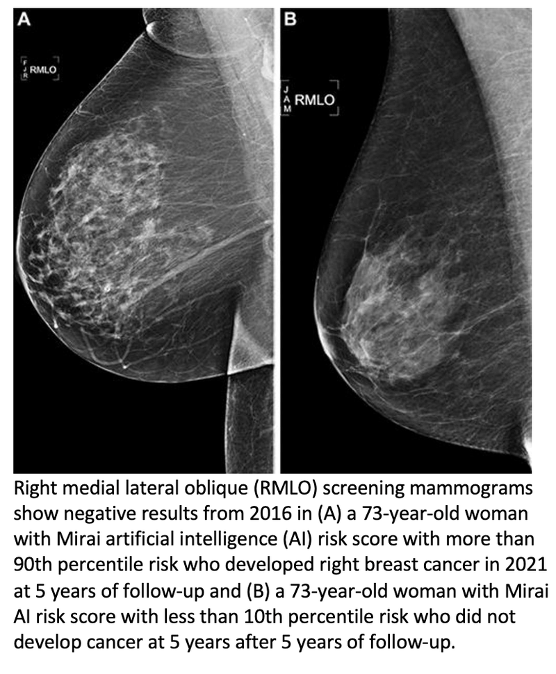AI Predicts Breast Cancer Risk Better Than Standard Clinical Risk Model