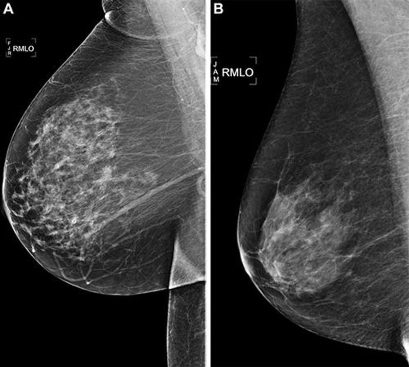 Tissue Stiffening in HER2-Negative Breast Cancer Can Drive Metastases