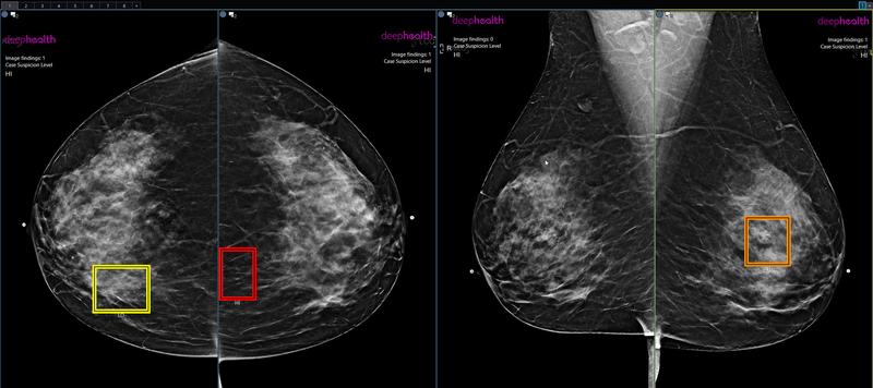 Women Will Pay for AI-Enhanced Breast Cancer Screening