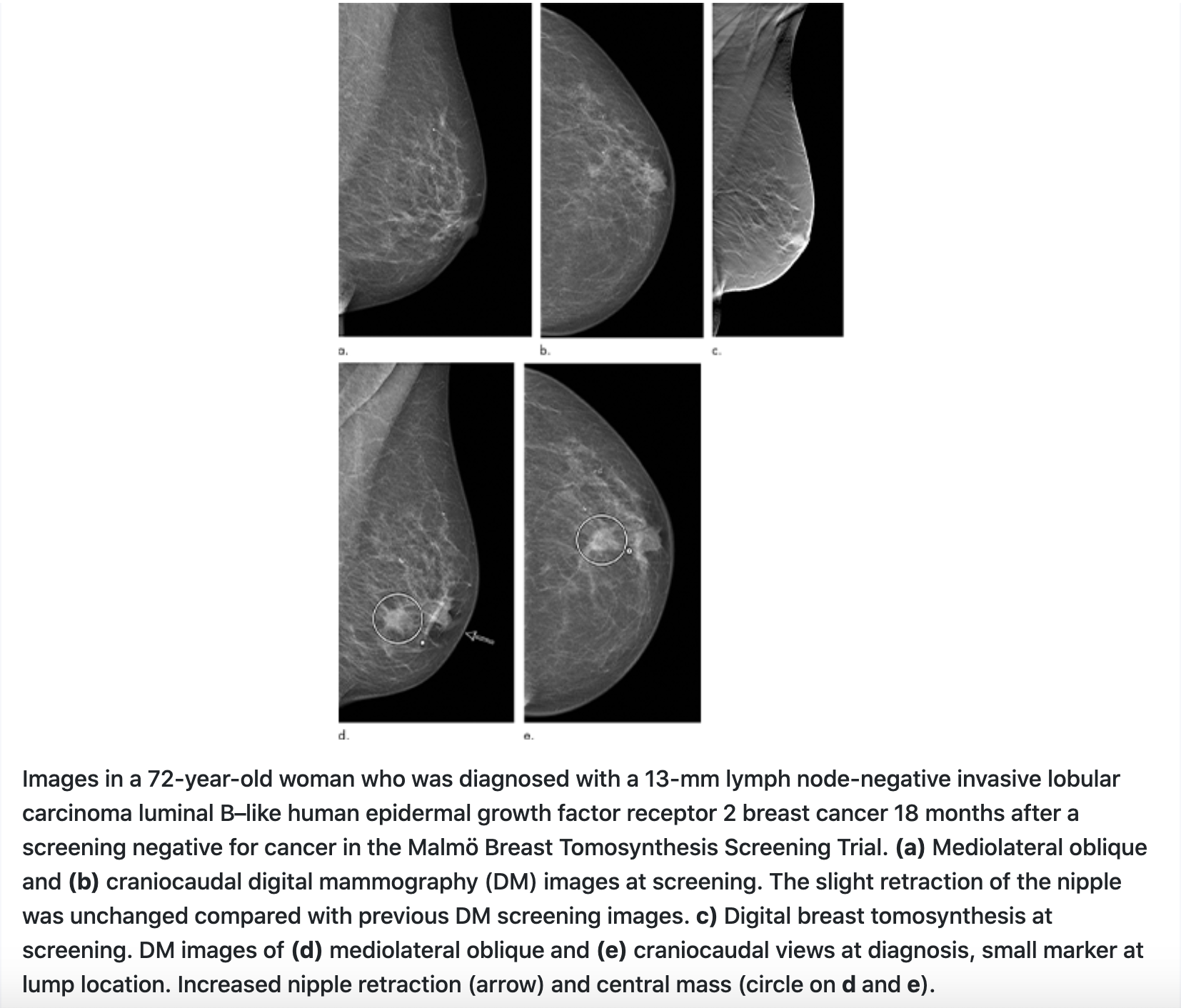 Study Reports Reduced Rate of Interval Cancers with DBT