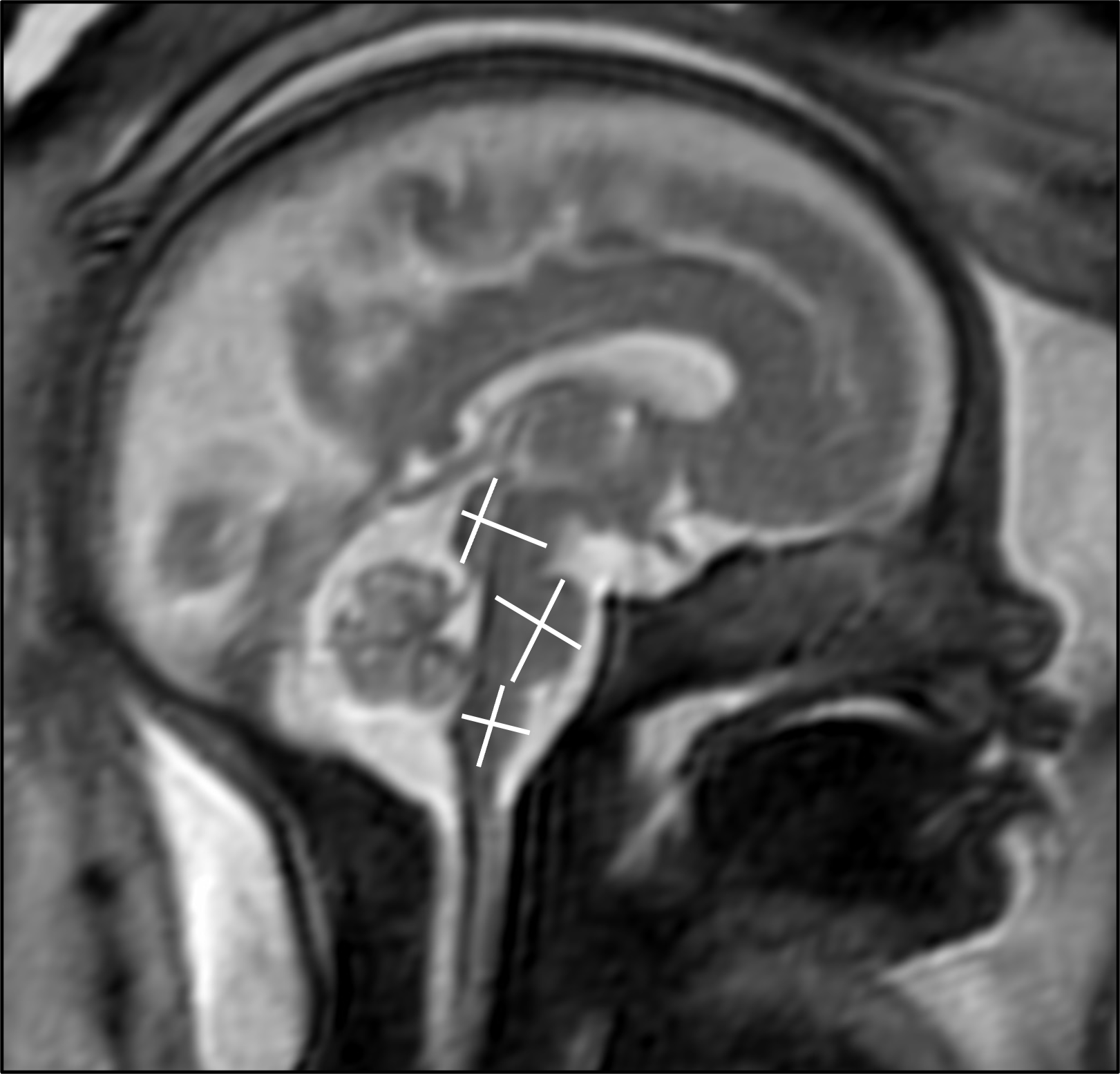 Fetal MRI on Pregnant COVID-19 Patients Finds no Harm to Baby’s Brain