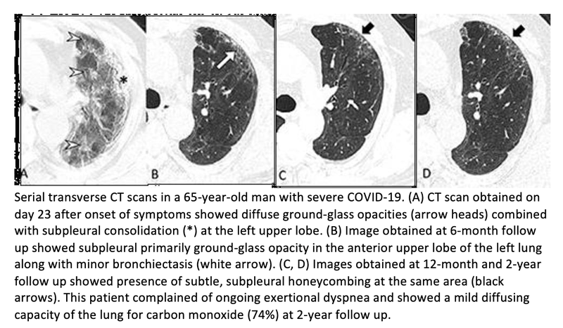 Lung Abnormalities Found on Chest CT Two Years After COVID