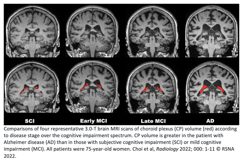 Increased Choroid Plexus Volume Linked to Alzheimer Disease