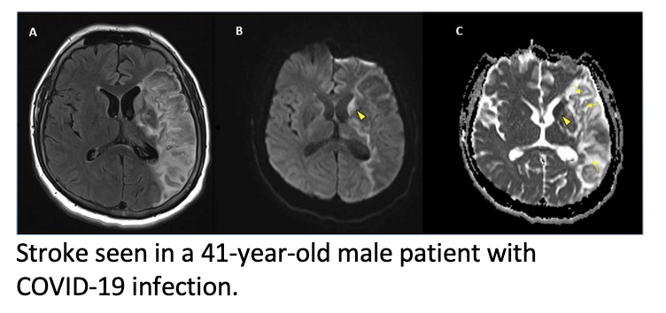 Large International Study Reports Brain Complications in COVID-19 Patients