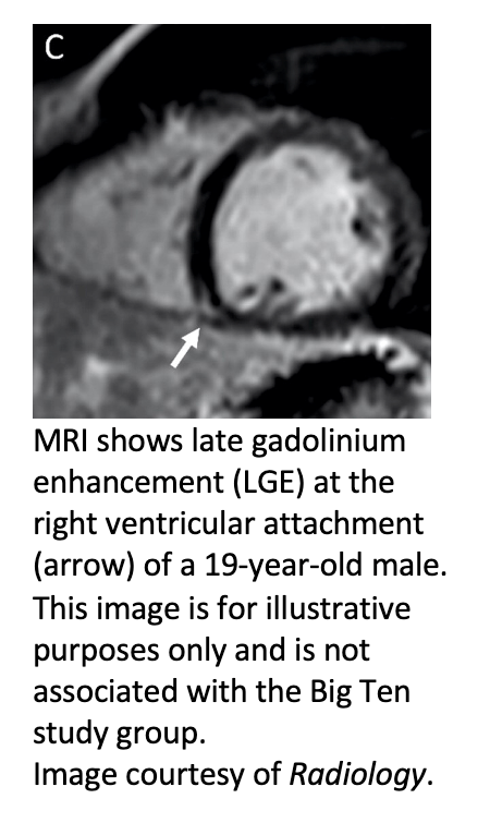 MRI Detects Myocarditis in College Athletes with COVID-19
