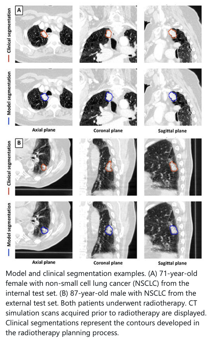 Deep-Learning Model Helps Detect Lung Tumors Using CT Scans