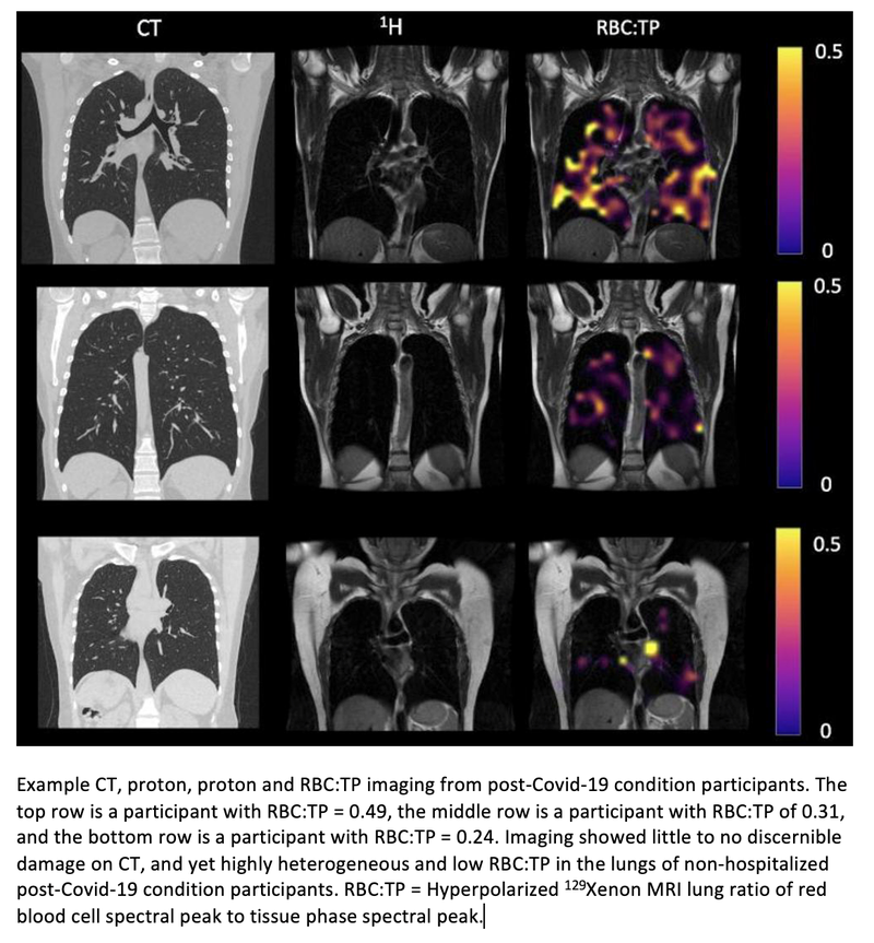 MRI Technique Detects Lung Abnormalities in Non-Hospitalized Long COVID Patients