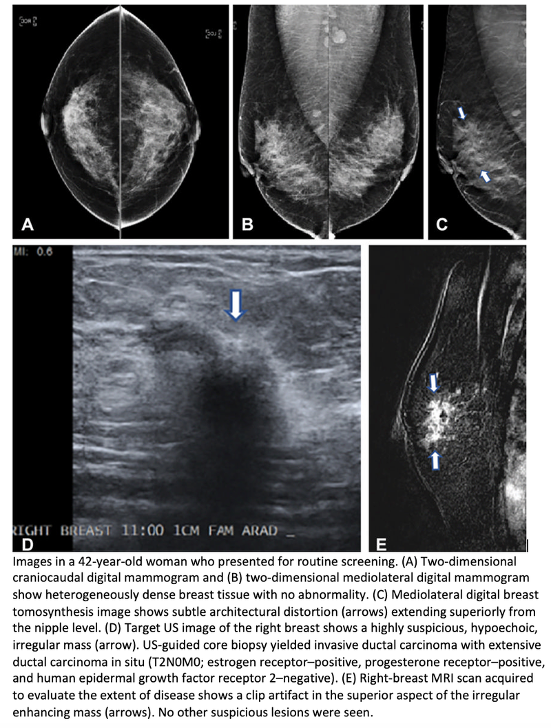 Tomosynthesis Better Than Digital Mammography for Breast Cancer Screening