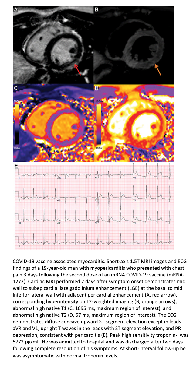 MRI Provides Insight on Vaccine-related Myocarditis