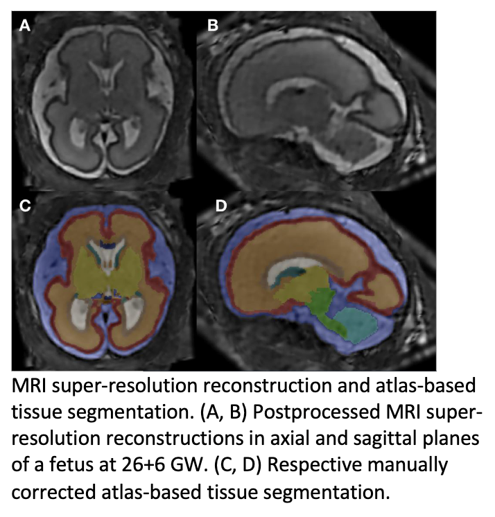 Fetuses Exposed to Alcohol Have Altered Brain Structure