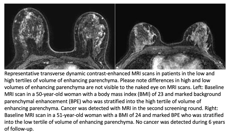 Background MRI Enhancement Increases Cancer Risk in Women With Very Dense Breasts