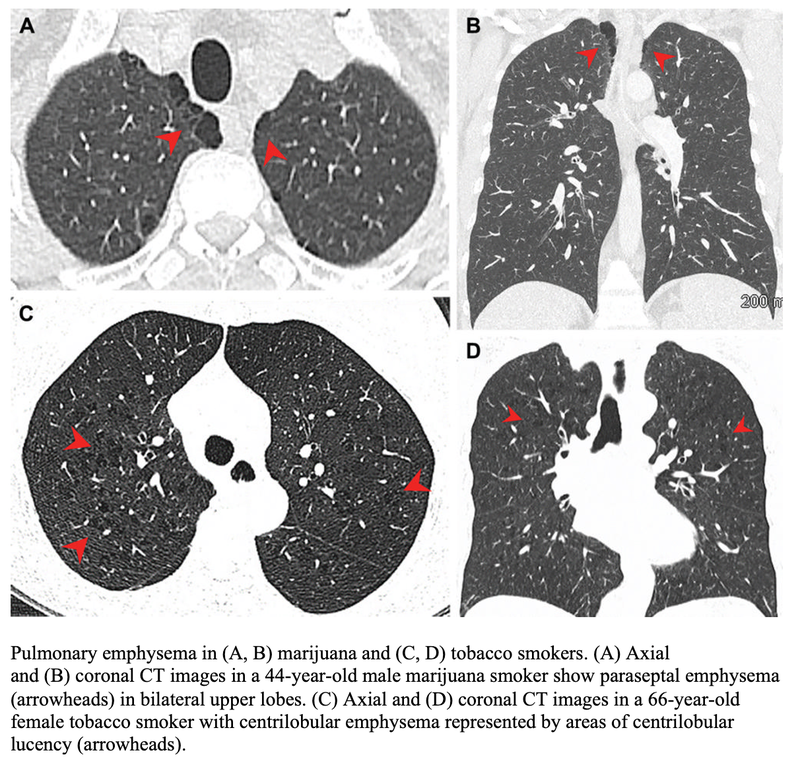 Emphysema, Airway Inflammation More Common in Marijuana Smokers Than Cigarette Smokers