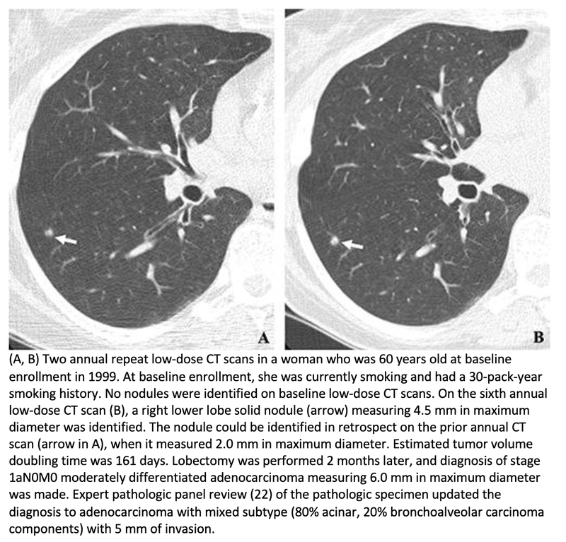 Lung Cancer Screening Significantly Increases Long-Term Survival