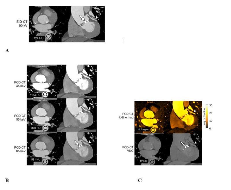 Study Finds Photon Counting CT Outperforms State-of-the-Art CT
