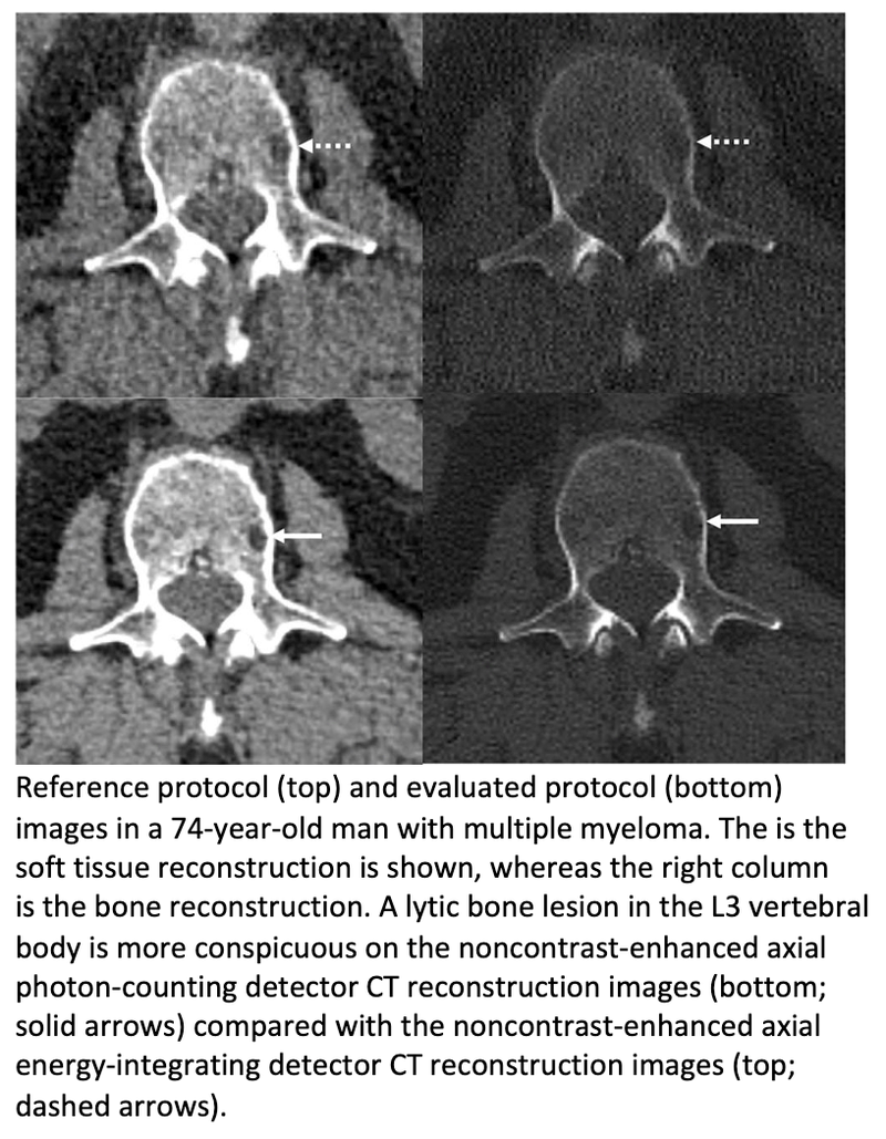 Photon-Counting CT with AI Improves Myeloma Bone Disease Detection at Lower Doses