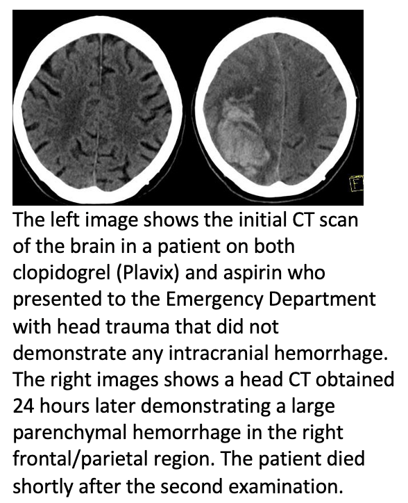 Patients on Older Blood Thinners may be at Higher Risk for Brain Bleeding after Head Trauma