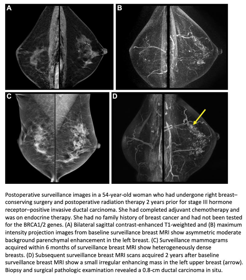 MRI Links Breast Tissue Features With Future Second Breast Cancer Risk