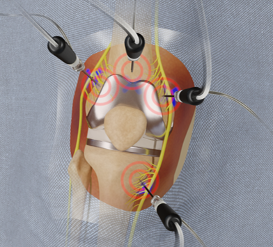 Cooled RFA Delivers Long-term Pain Relief in Knee Replacement Patients