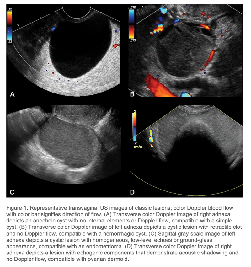 Ultrasound Predicts Ovarian Cancer