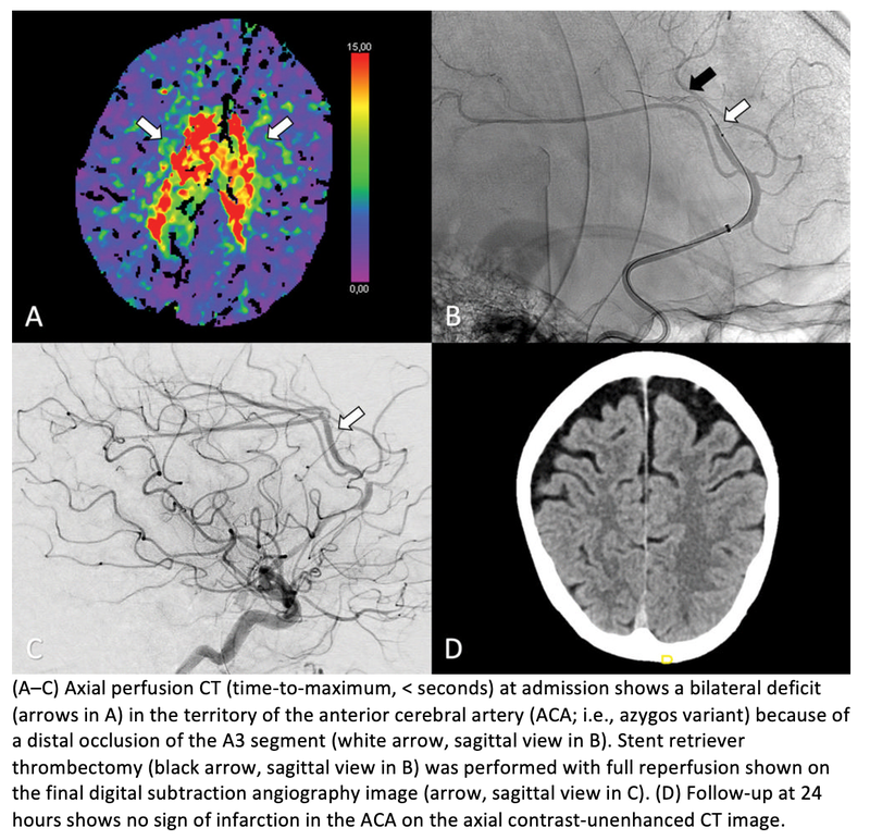Thrombectomy is Safe and Effective for Occlusions of the Anterior Cerebral Artery